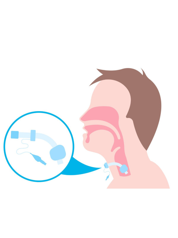 Rurka Tracheostomijna Silikonowa Po Laryngektomii Servox Soft Tube 22mm Bez Fenestracji Rozmiar 8