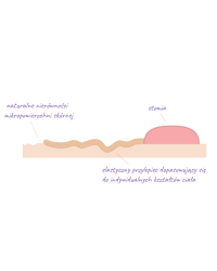 ACFXL115 Worek Stomijny Jednoczęściowa Zamknięty 15-70 mm Aurega 1 Closed Extra Duży Beżowy Cortmed