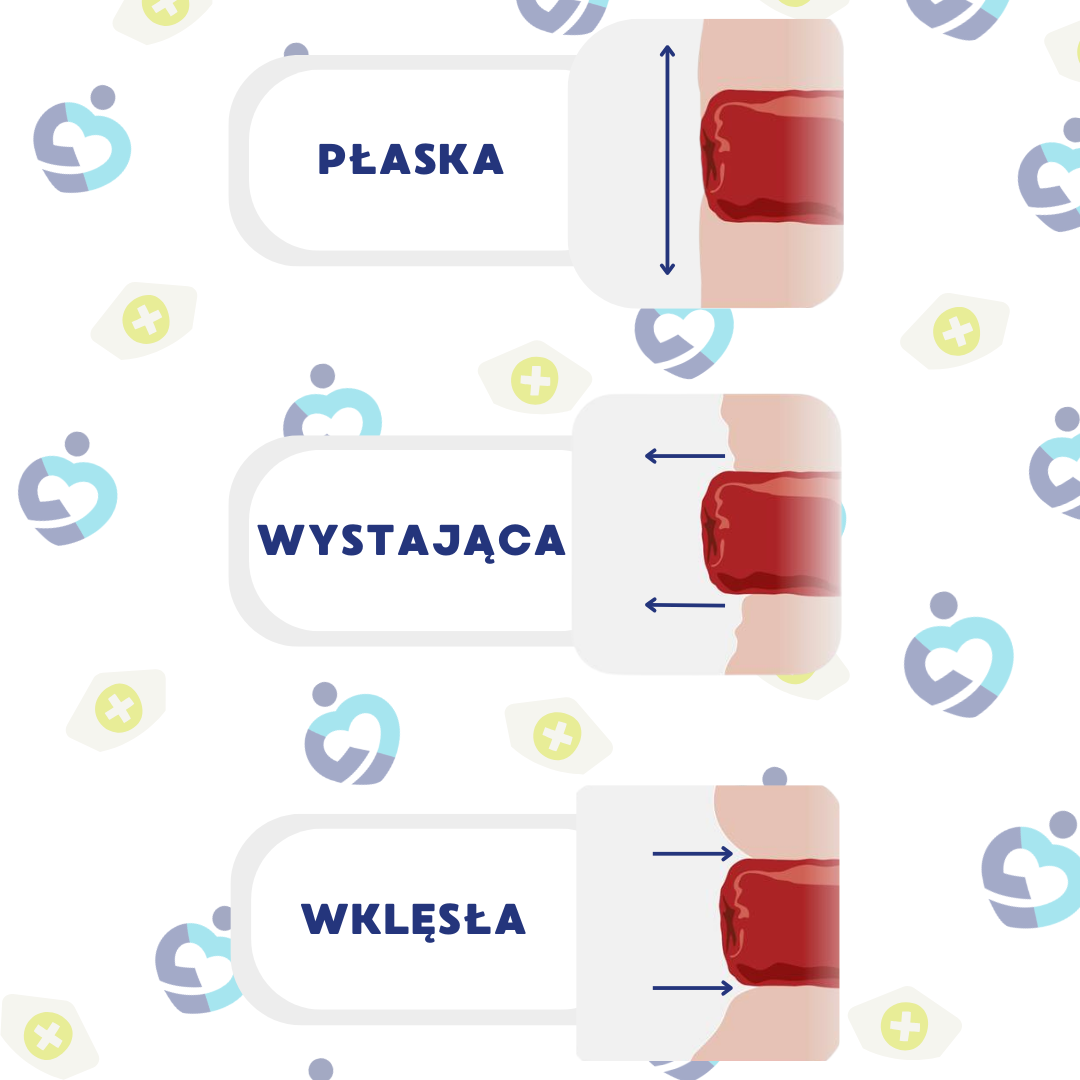 Rodzaje stomii: płaska – na poziomie skóry, wypukła – wystaje ponad skórę, wklęsła – zagłębiona poniżej poziomu skóry; różnice istotne przy doborze sprzętu stomijnego