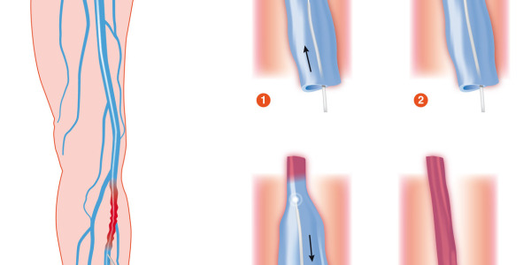 Jak powstają żylaki kończyn dolnych? Przyczyny, rodzaje i objawy żylaków