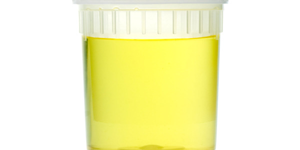 Ciemny mocz – co oznacza? Przyczyny brązowego, brunatnego moczu