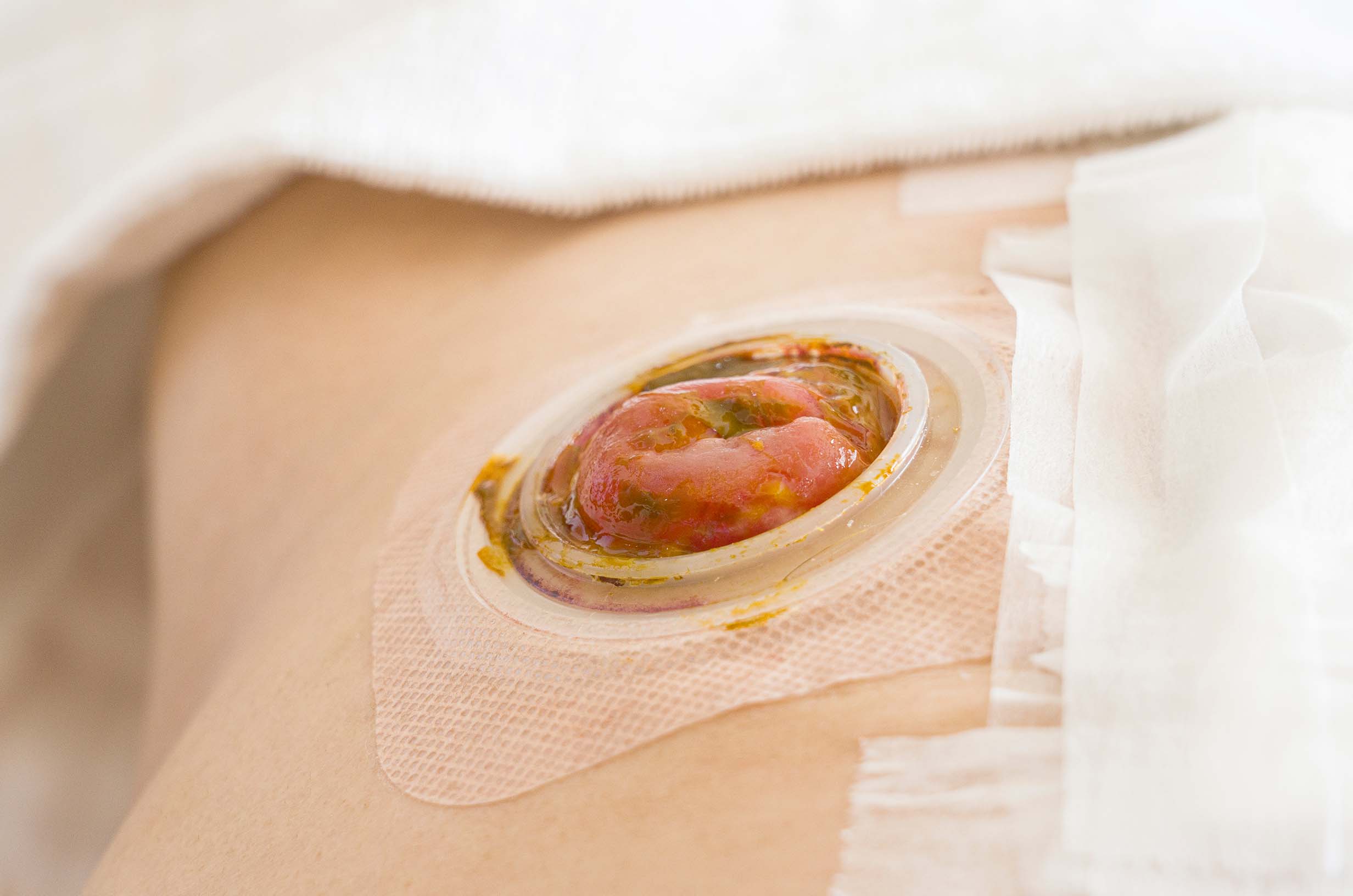 Operacja wyłonienia stomii - Kompendium wiedzy